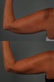 Liposuction Arms
