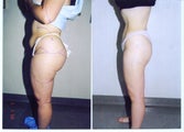 Liposuction Abdomen, Hips, Buttocks and Thighs