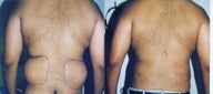 Liposuction Love Handles