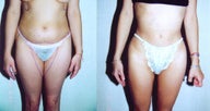 Liposuction Abdomen and Thighs