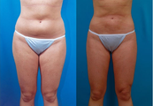 Liposuction
