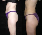 Liposuction