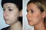 Rhinoplasty and liposuction under chin