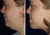 Liposuction of Chin