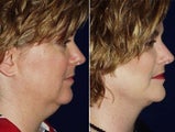 Liposuction of double chin and facelift