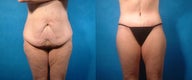 Lower Body Lift