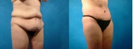 Lower Body Lift