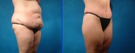 Lower Body Lift