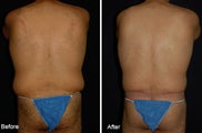 Lower Bodylift