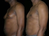 Gynecomastia