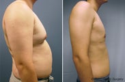 Male Breast Reduction