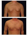 Gynecomastia (Male Breast Reduction)