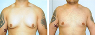 Gynecomastia surgery