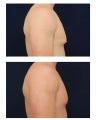 Gynecomastia