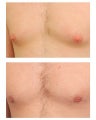 Gynecomastia