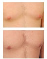 Gynecomastia