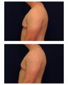Gynecomastia / Male Breast Reduction