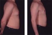 Gynecomastia (Male Breast Reduction)