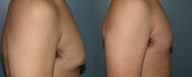 Gynecomastia (male breast reduction) 