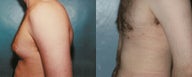 Gynecomastia (Male Breast Reduction)