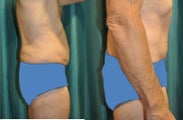 male tummy sculpting