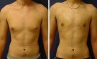 Gynecomastia