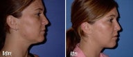 Mesotherapy to chin and jaw line