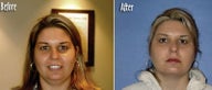 Mesotherapy to reduce double chin