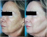 Laser Resurfacing