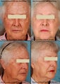 MiXto Laser Resurfacing 