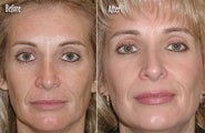  Microdermabrasion Full Face
