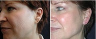  Juvederm Ear LobeTreatment