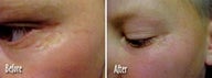  Microdermabrasion Scar Repair