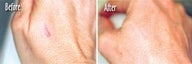  Microdermabrasion of Scars on Hands