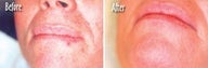  Microdermabrasion Chin and Mouth