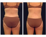 Tummy Tuck or Abdominoplasty