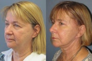 Lite Lift, upper and lower eyelid lift, liposuction of the neck, blue peel