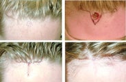 MOHS Skin Cancer Surgery