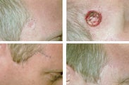 MOHS Skin Cancer Surgery