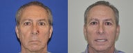 Skin Cancer Reconstruction of the Nose