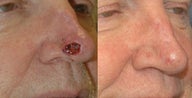 Nasal defect repair after Mohs skin cancer surgery