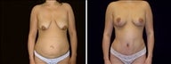 29 year old female, Mommy Makeover