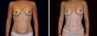 38 year old female, Mommy Makeover