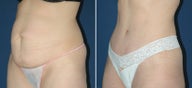 Tummy Tuck