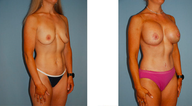 Tummy tuck, breast lift with implants, liposuction
