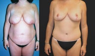 Breast Lift, Tummy Tuck and Liposuction