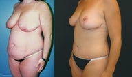Breast Lift, Tummy Tuck and Liposuction