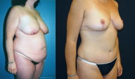 Breast Lift, Tummy Tuck and Liposuction