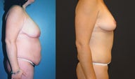 Breast Lift, Tummy Tuck and Liposuction