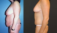 Breast Lift, Tummy Tuck and Liposuction